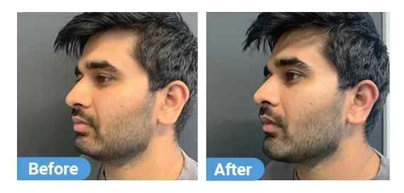 Jaw filler-2