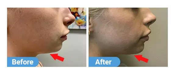 Kybella-1