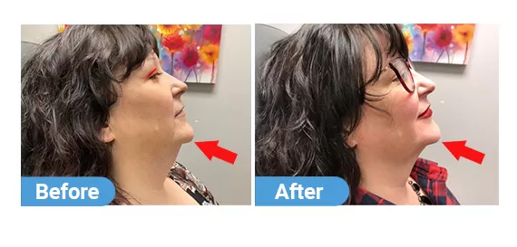 Kybella-2