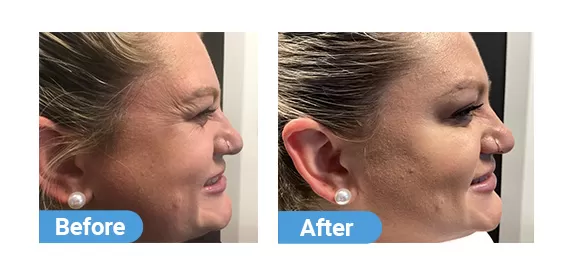 botox injection case 04