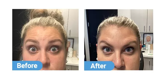 botox injection case 05