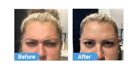 botox injection case 06