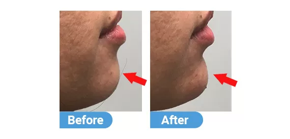 chin-filler-2