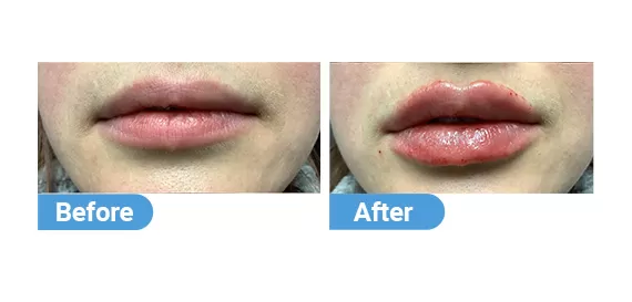 lip-filler-10