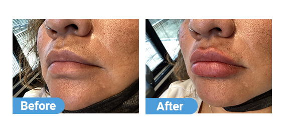 lip-filler-6