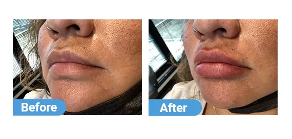 lip filler case 06