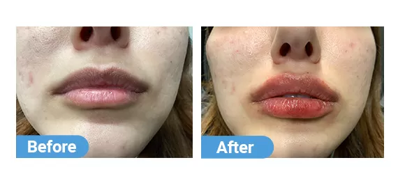lip filler case 07