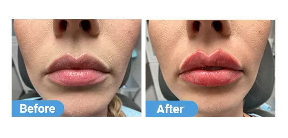 lip filler case 08