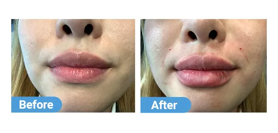 lip-filler-9