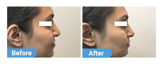 non-surgical-rhinoplasty-2
