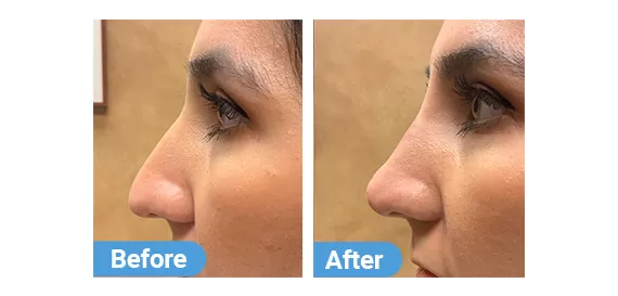 non-surgical-rhinoplasty-3