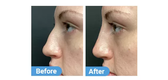non-surgical-rhinoplasty-5